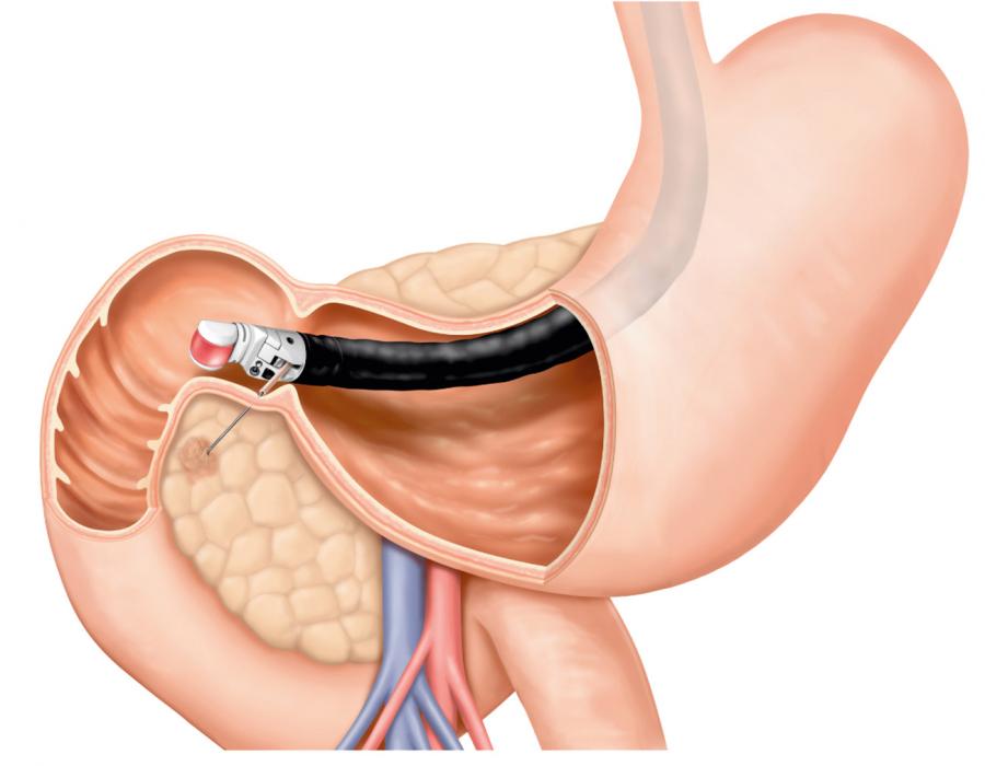 Endoscopic Ultrasound in Rasta Peth, Pune