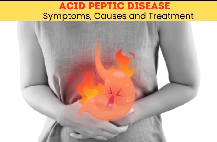 Acid Peptic Disease: Symptoms, Causes and Treatment