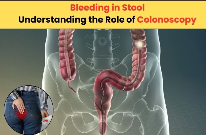 Bleeding in Stool: Understanding the Role of Colonoscopy