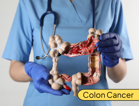 Colon Cancer