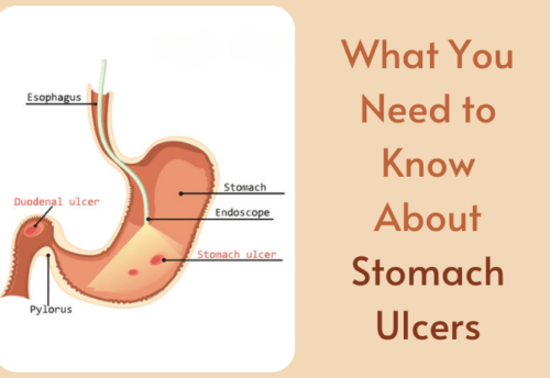 stomach ulcer