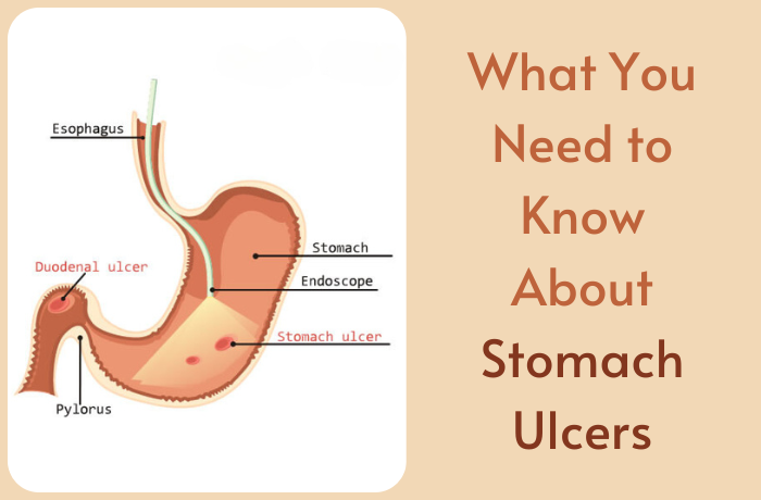 stomach ulcer