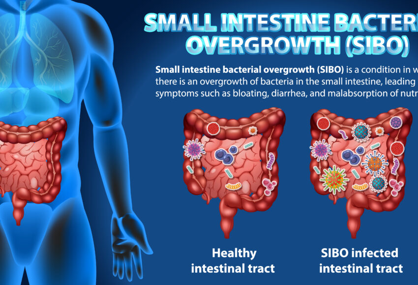 SIBO