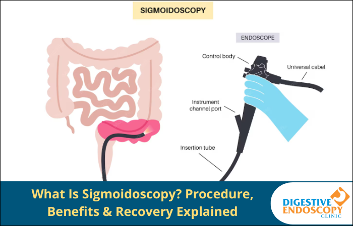 Sigmoidoscopy procedure explained